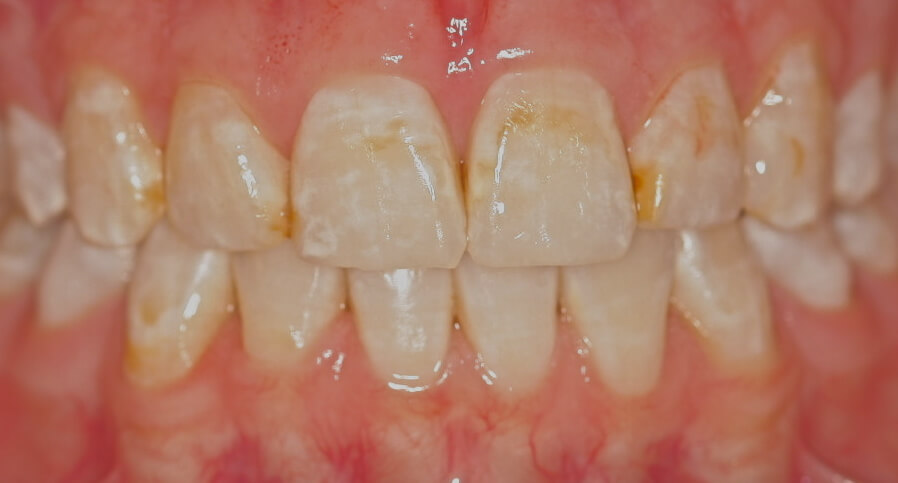 Before: Tooth-colored fillings on front six upper teeth
