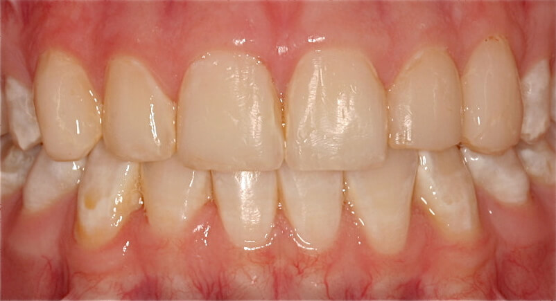 After: Tooth-colored fillings on front six upper teeth
