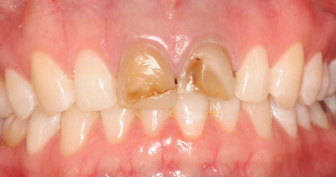Before: All-ceramic crowns on two upper front central incisors