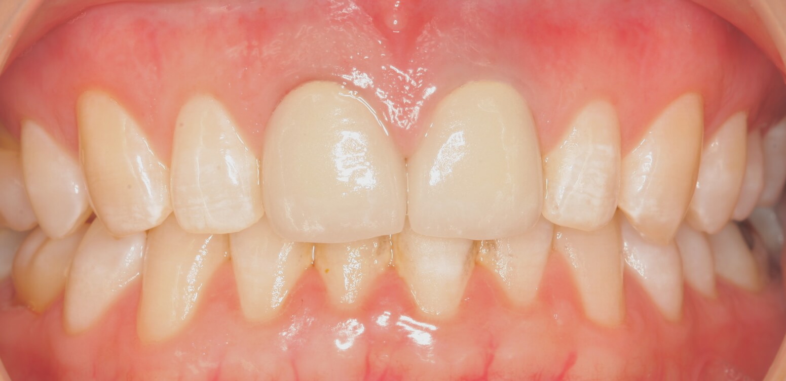 After: All-ceramic crowns on two upper front central incisors