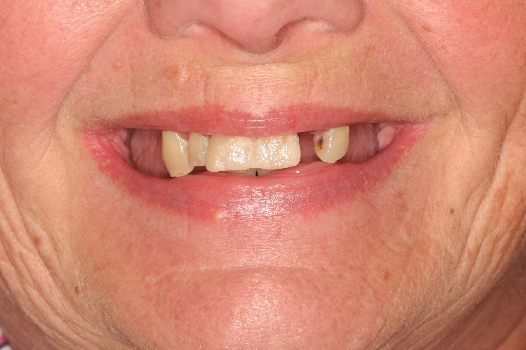 Before: All teeth extracted, 7 implants with upper and lower implant-supported removable dentures
