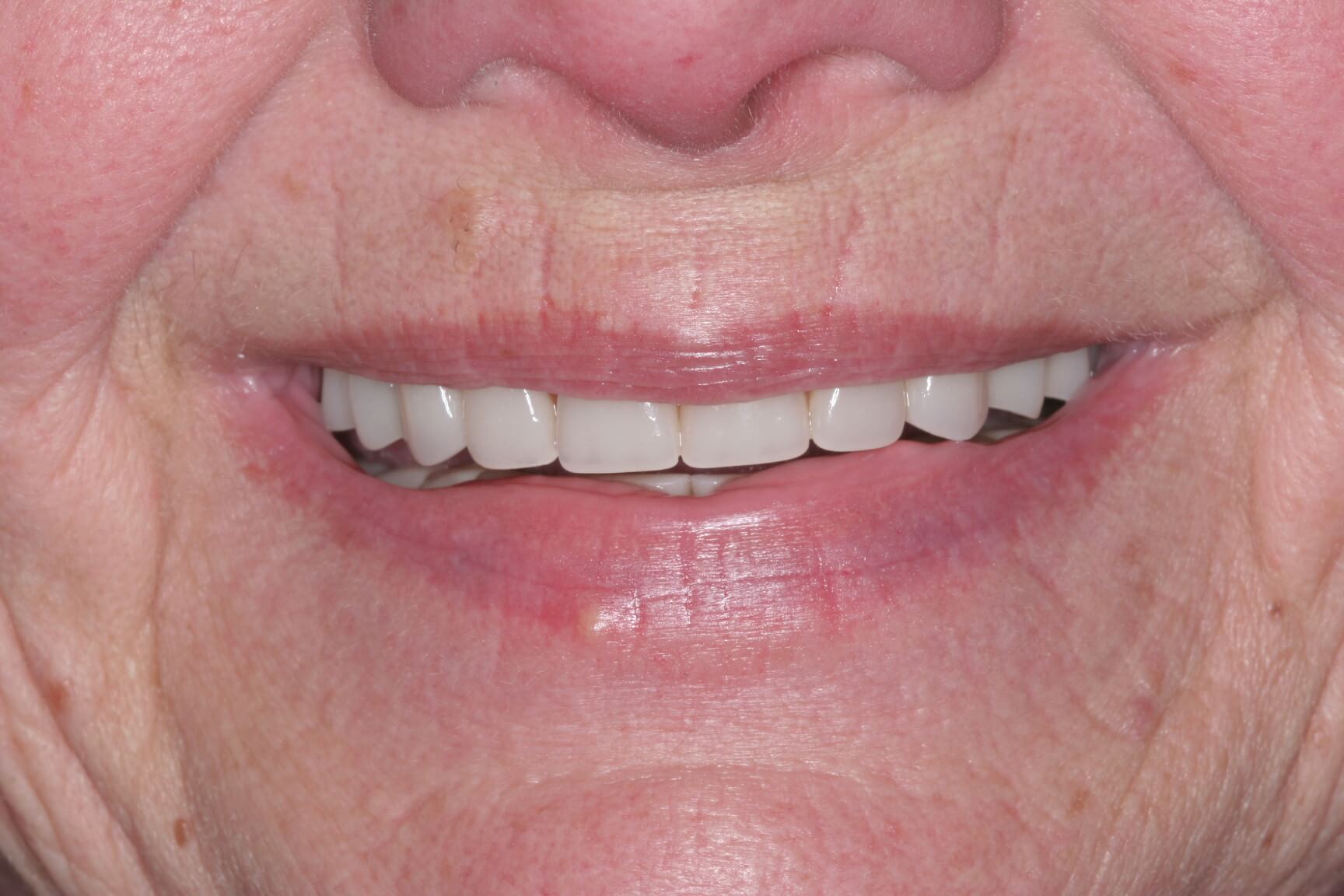 After: All teeth extracted, 7 implants with upper and lower implant-supported removable dentures