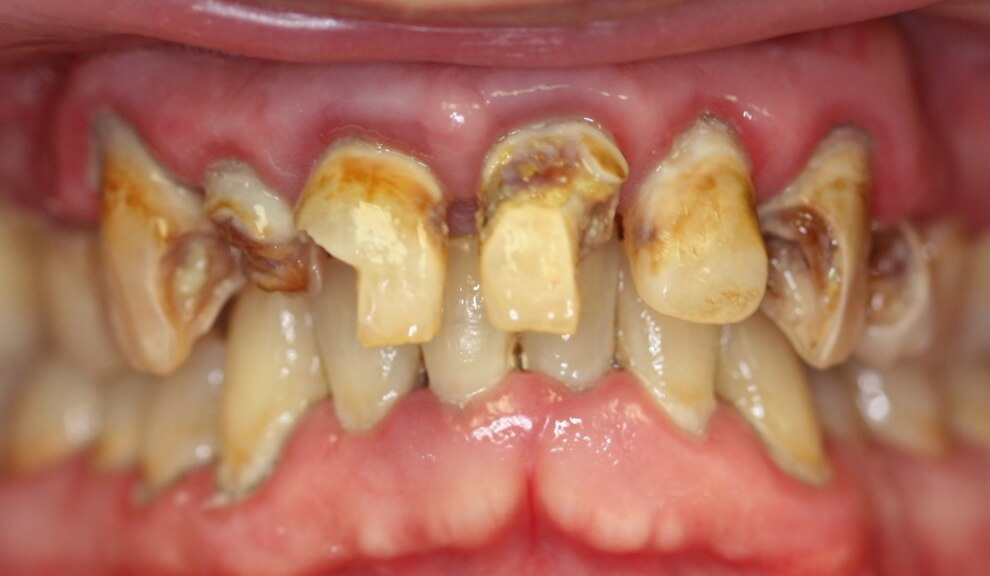 Before: Combination of tooth colored fillings and removable partial denture