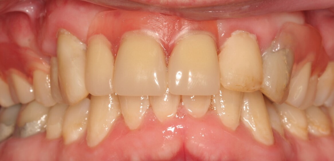 After: Combination of tooth colored fillings and removable partial denture