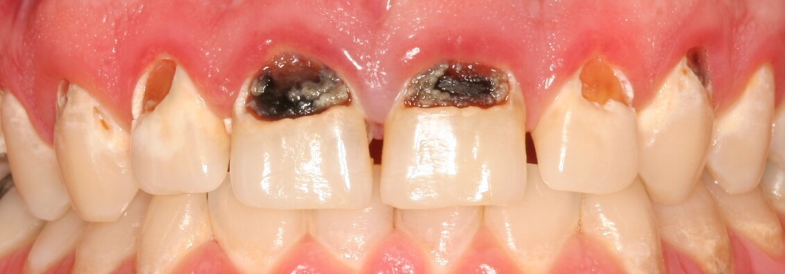 Before: Tooth-colored fillings on front six upper teeth