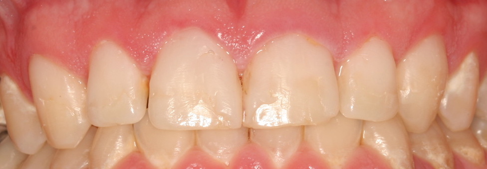 After: Tooth-colored fillings on front six upper teeth