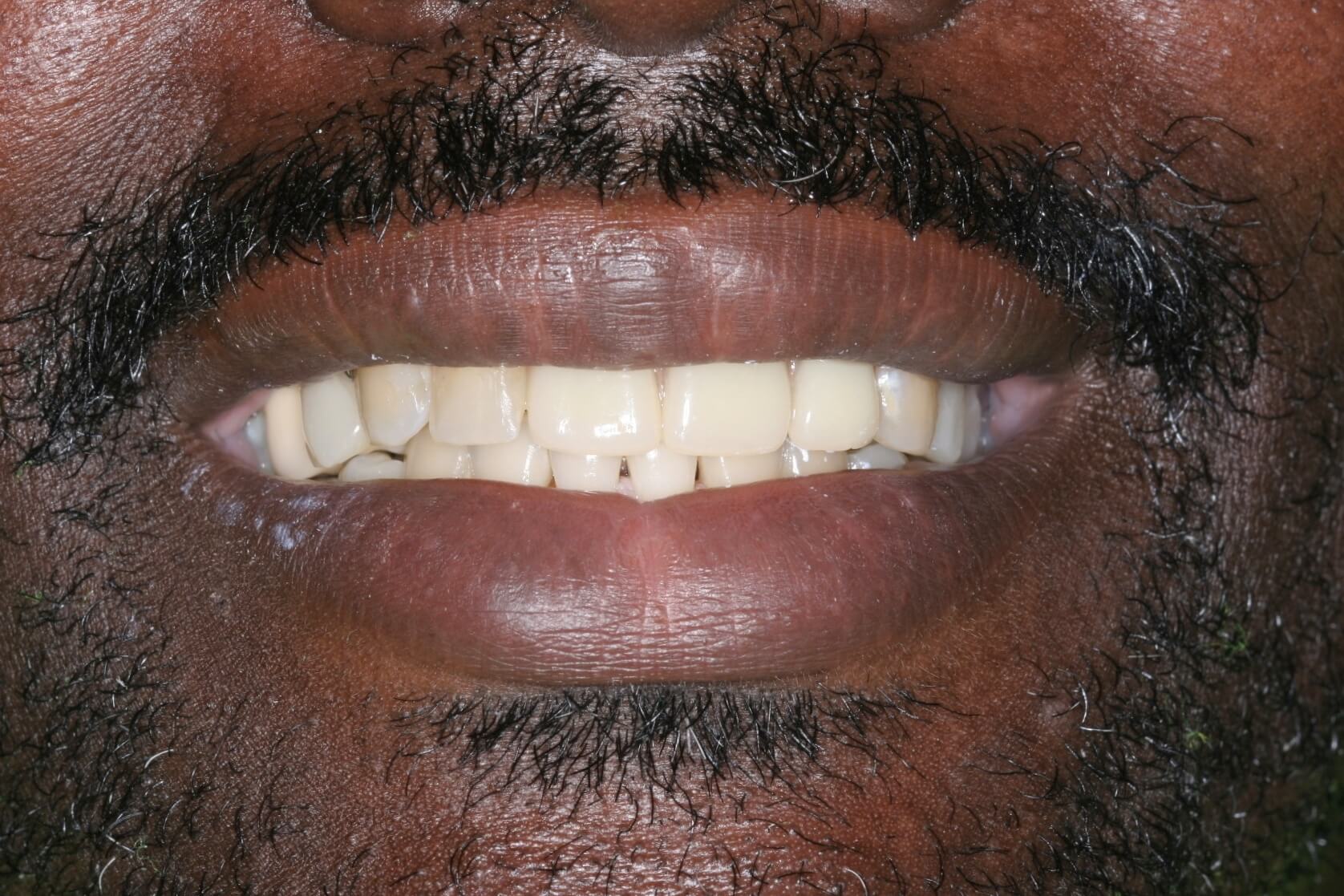After: Upper and lower removable partial dentures
