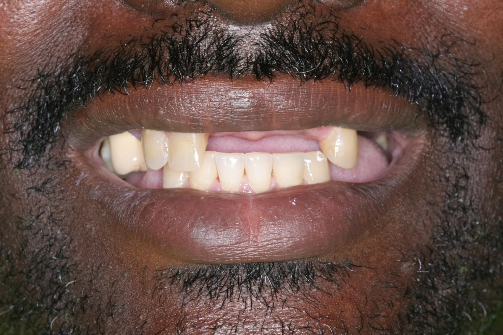 Before: Upper and lower removable partial dentures