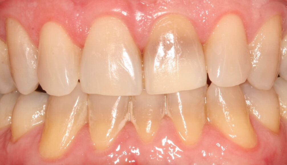 Before: All-ceramic crown on front tooth to mask discoloration