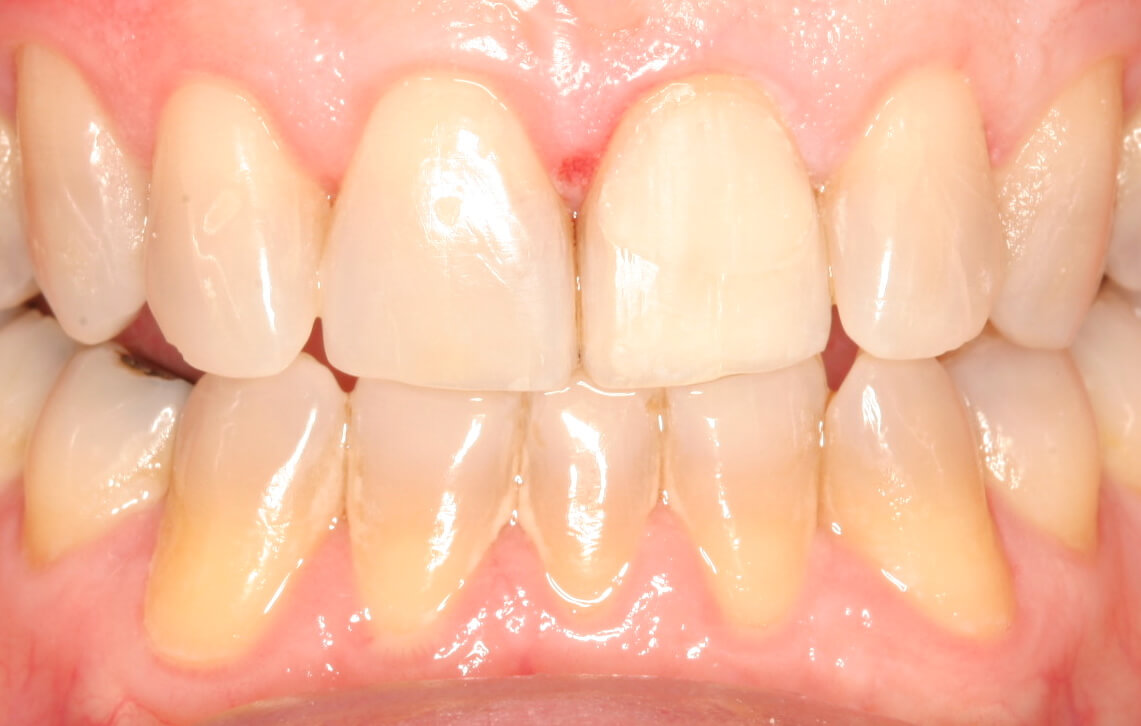 After: All-ceramic crown on front tooth to mask discoloration